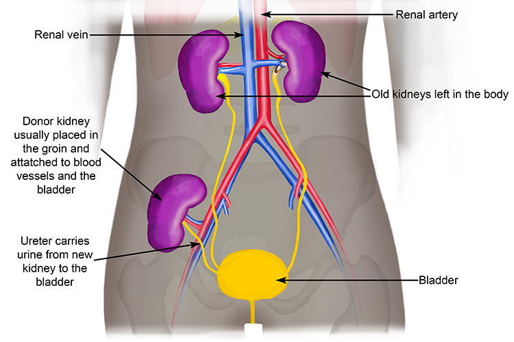 A Kidney transplant the ultimate treatment to avoid dialysis
